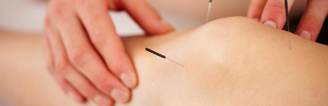 acupuncture Benen